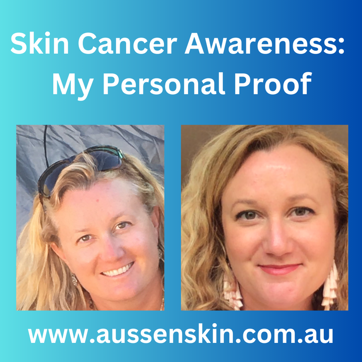 My Skin Cancer Story and Why Aussenskin Sunscreens Are Safe